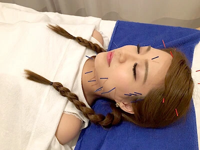 『鍼』が肌トラブルにいいらしい？！