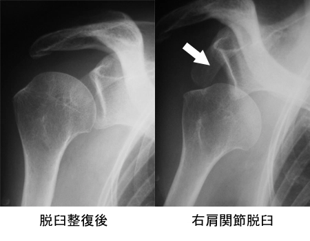 肩関節前方脱臼