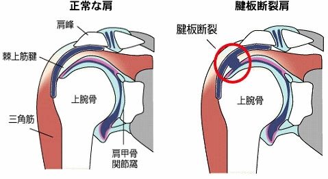 肩腱板損傷