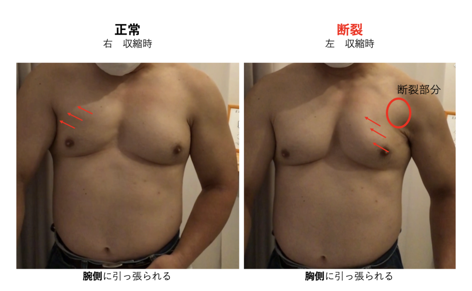 筋 損傷 と は