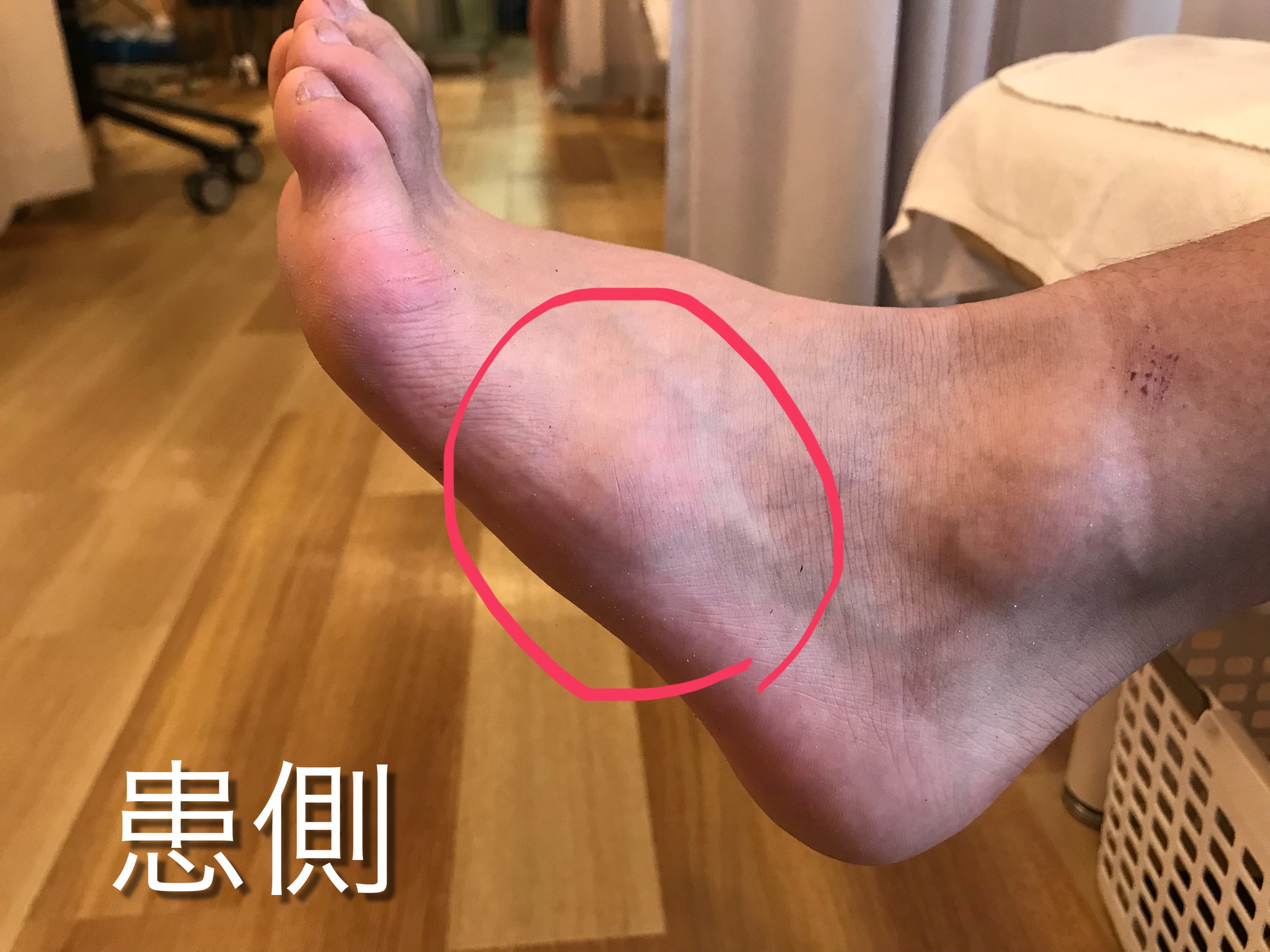 足首を骨折した場合、それは何を意味しますか?