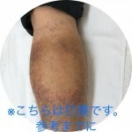 リハビリのタイミングと度合い