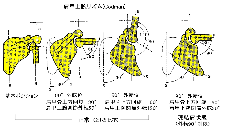一般的には保存療法(リハビリ)で行われます