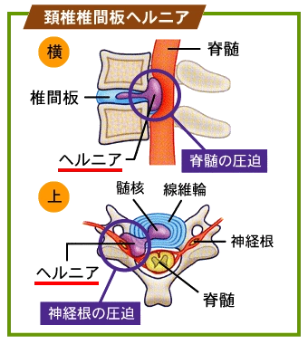 ① 神経根型