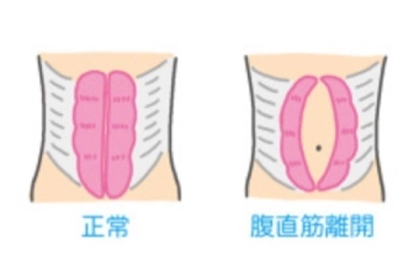 筋力低下