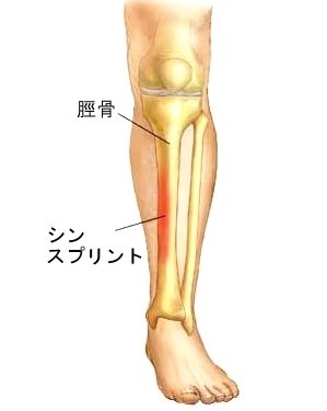 疲労骨折