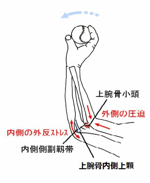野球肘（離断性骨軟骨炎）