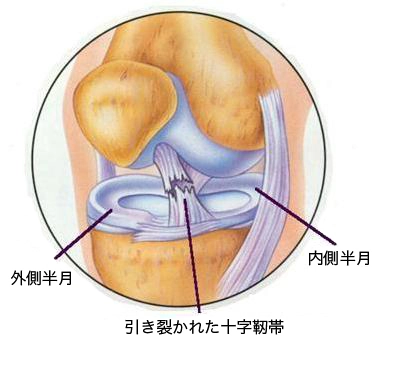 膝後十字靭帯（PCL）損傷