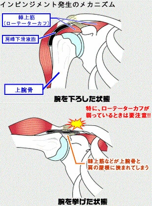 なぜインピンジメントを起こすのか