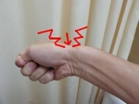 腱鞘炎(ドケルバン)の判断方法