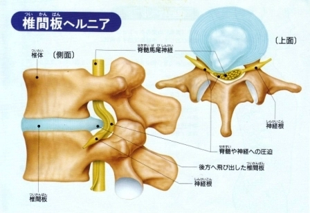 腰椎椎間板ヘルニア