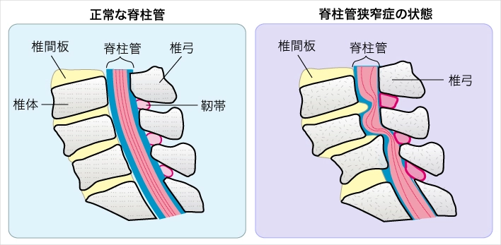 腰椎分離・すべり症